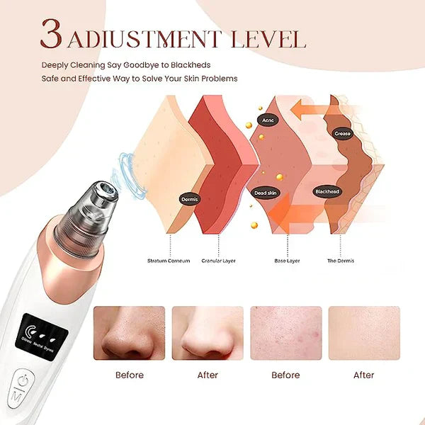 Electric Blackhead Remover Pore Vacuum Sucction machine sab lejao